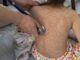 Aumentan a mil 520 los casos de sarampión en México; reportan cuatro muertes
